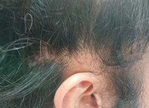 西尾市のI様(30代男性) 耳の上部 円形脱毛