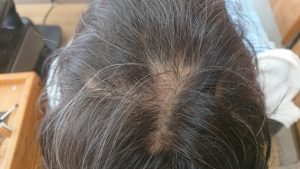 つむじ付近やサイドに目立つ円形脱毛症脱毛症1