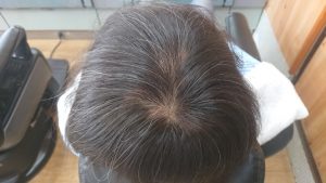 天頂部の円形脱毛症部位へ増毛施術
