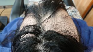 女子中学生の円形脱毛症ケア 頭頂部位1月撮影