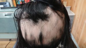 女子中学生の円形脱毛症ケア 後頭部位2月撮影