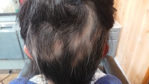 女子中学生の円形脱毛症ケア 後頭部位4月撮影