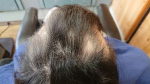 女子中学生の円形脱毛症ケア 頭頂部位4月撮影