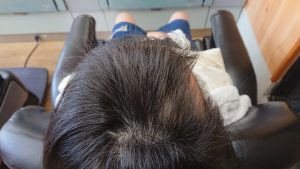 女子中学生の円形脱毛症ケア 頭頂部位5月撮影