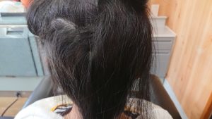 女子中学生の円形脱毛症ケア 後頭部位5月撮影