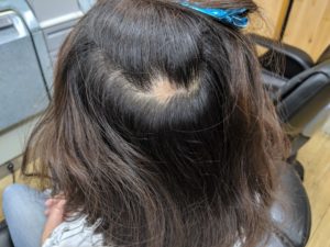 刈谷市の円形脱毛症(女性) 右側頭部に約5センチ大