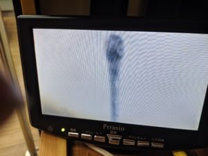 抜け毛の毛根観察