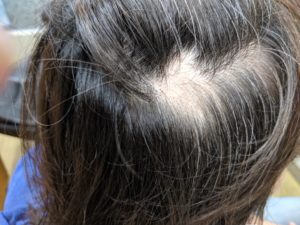 刈谷市の円形脱毛症(女性) 後頭部左上部に約2センチ大