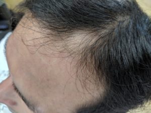 円形脱毛症ケア(32歳 男性) 前頭部生え際