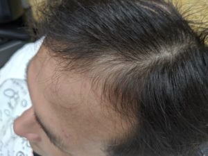 円形脱毛症ケア(32歳 男性) 前頭部生え際 回復