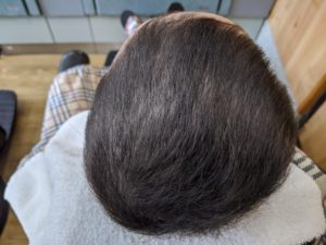 円形脱毛症 小学生(女の子)_4