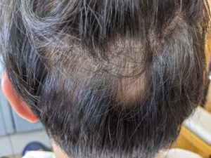 岡崎市のMさま(20代 男性) 後頭部の円形脱毛症回復