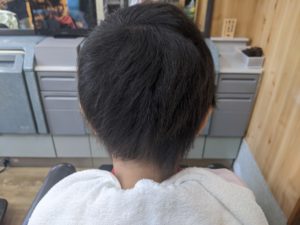 円形脱毛症 小学生(女の子) 回復後1