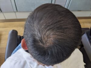 大府市のSさま(男性) つむじ周辺増毛後