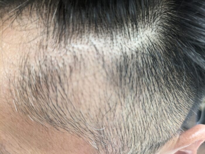 Sさん(男性40代、豊田市)が 約2年ぶりの円形脱毛症施術