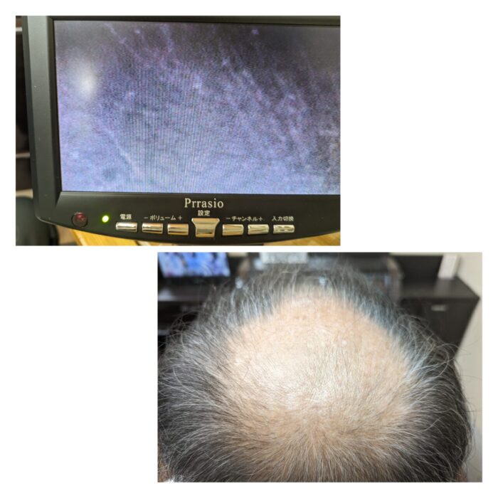 刈谷市の男性(60代) 男性型脱毛症(AGA)ケア 回復