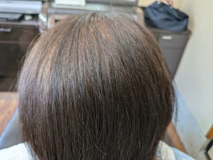 女性のつむじ割れ 増毛後